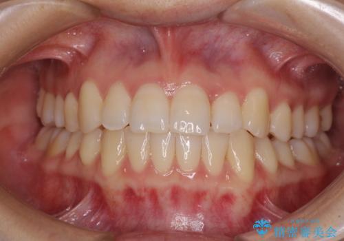 前歯のクロスバイト インビザラインによる矯正治療の症例 治療後