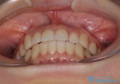 前歯のクロスバイト インビザラインによる矯正治療の治療後