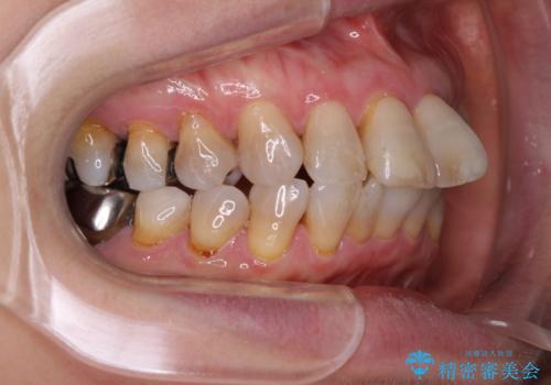 出っ歯を改善した後に真っ白な歯に 矯正歯科治療と審美歯科治療の治療前