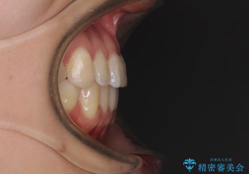 前歯のクロスバイト インビザラインによる矯正治療の治療後