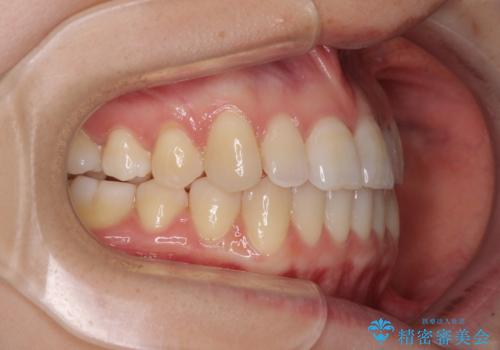 前歯のクロスバイト インビザラインによる矯正治療の治療後