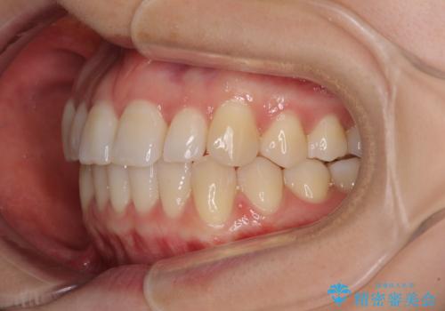 前歯のクロスバイト インビザラインによる矯正治療の治療後