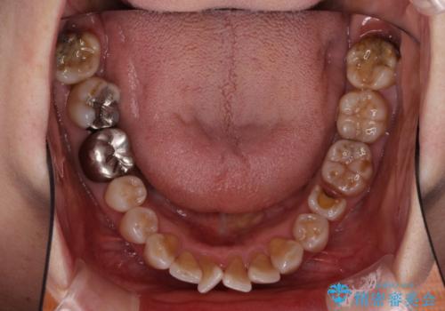 出っ歯を改善した後に真っ白な歯に　矯正歯科治療と審美歯科治療の治療前