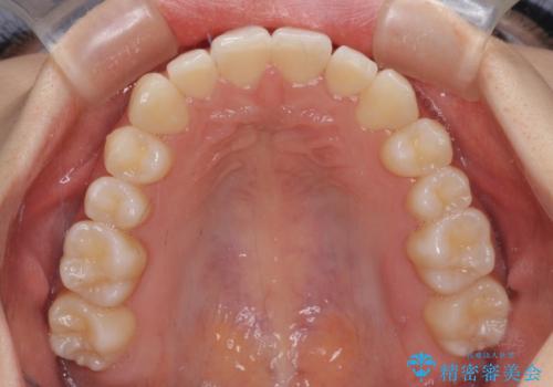 前歯のクロスバイト インビザラインによる矯正治療の治療後