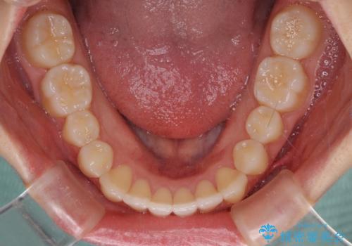 前歯のクロスバイト インビザラインによる矯正治療の治療後