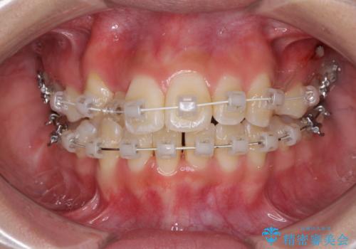 前歯の正中のズレを改善 目立たないワイヤー装置での抜歯矯正の治療中