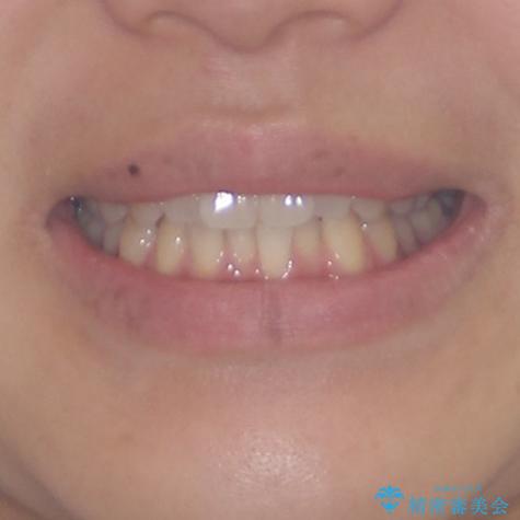 インプラントによる補綴治療とインビザライン矯正の治療前(顔貌)