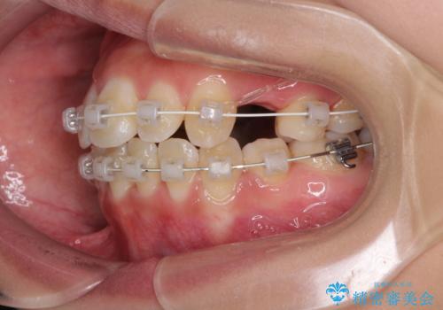 前歯の正中のズレを改善 目立たないワイヤー装置での抜歯矯正の治療中