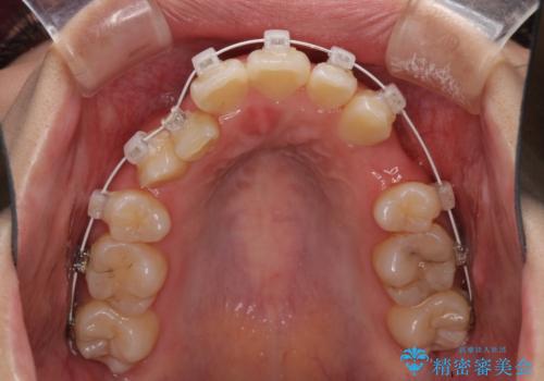 前歯の正中のズレを改善 目立たないワイヤー装置での抜歯矯正の治療中
