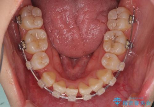 前歯の正中のズレを改善 目立たないワイヤー装置での抜歯矯正の治療中