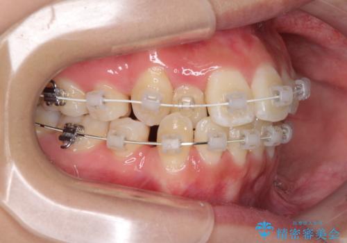前歯の正中のズレを改善　目立たないワイヤー装置での抜歯矯正の治療中