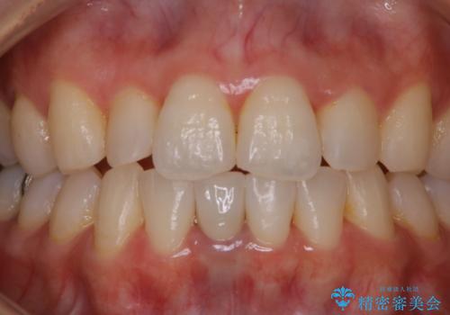 ナイトガードを作成前にPMTCできれいにの治療前