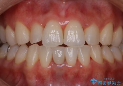 ナイトガードを作成前にPMTCできれいにの治療後