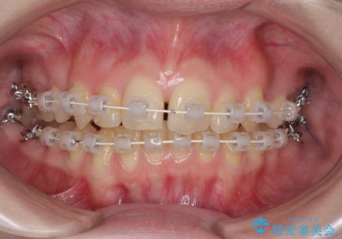 八重歯を短期間で改善　ワイヤー装置による抜歯矯正の治療中