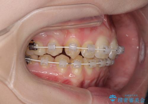 八重歯を短期間で改善 ワイヤー装置による抜歯矯正の治療中