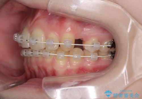 八重歯を短期間で改善 ワイヤー装置による抜歯矯正の治療中