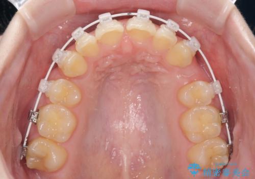 八重歯を短期間で改善 ワイヤー装置による抜歯矯正の治療中