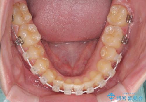 八重歯を短期間で改善 ワイヤー装置による抜歯矯正の治療中