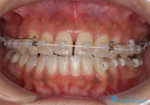 【モニター】幅の狭い上顎歯列 骨幅を拡大する矯正治療の治療中