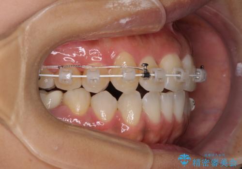 【モニター】幅の狭い上顎歯列 骨幅を拡大する矯正治療の治療中