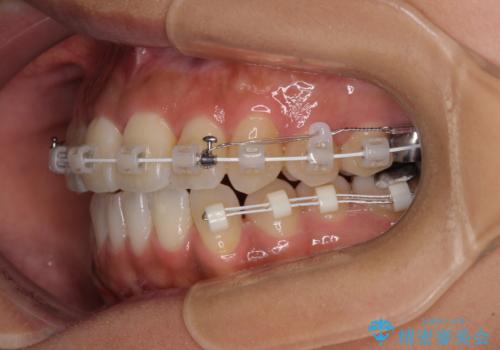 【モニター】幅の狭い上顎歯列 骨幅を拡大する矯正治療の治療中