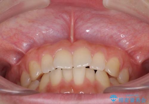 インプラントによる補綴治療とインビザライン矯正の治療前