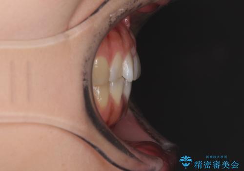 インプラントによる補綴治療とインビザライン矯正の治療前