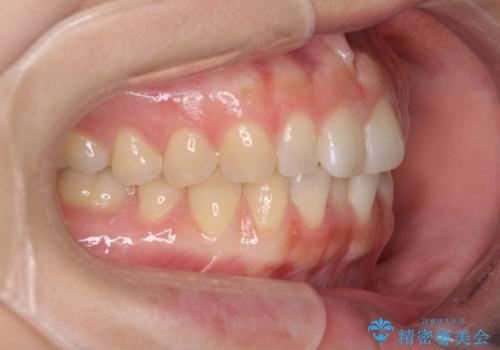 インプラントによる補綴治療とインビザライン矯正の治療前