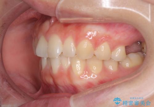 インプラントによる補綴治療とインビザライン矯正の治療前