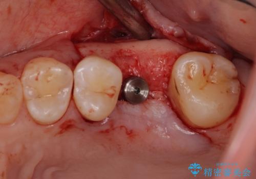 インプラントによる補綴治療とインビザライン矯正の治療中