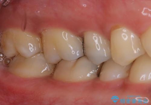 銀歯を白くしたい:適合の良い被せ物で長期間安心して使える歯にの治療前