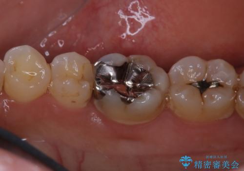 銀歯を白くしたい:適合の良い被せ物で長期間安心して使える歯にの治療前