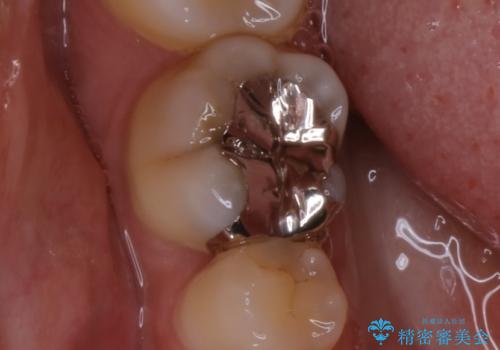 銀歯を白くしたい:適合の良い被せ物で長期間安心して使える歯にの治療前