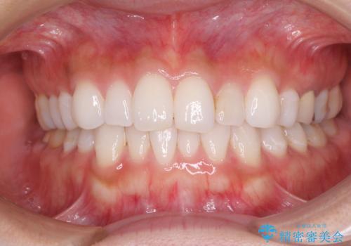 軽度の叢生をインビザライン・ライトで解消の症例 治療前