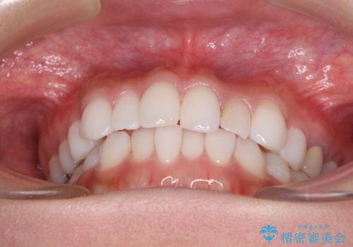 軽度の叢生をインビザライン・ライトで解消の治療前