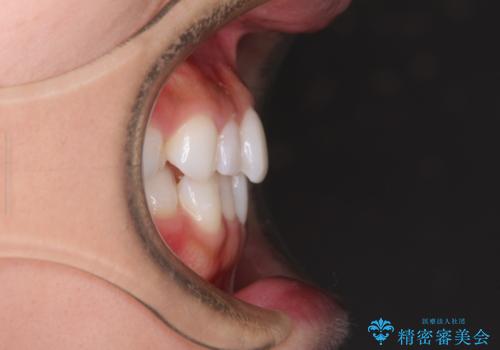 軽度の叢生をインビザライン・ライトで解消の治療前