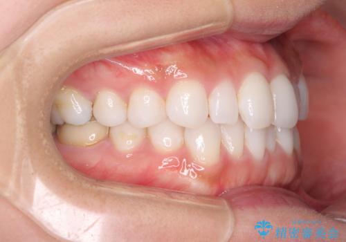 軽度の叢生をインビザライン・ライトで解消の治療前