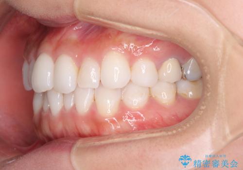 軽度の叢生をインビザライン・ライトで解消の治療前