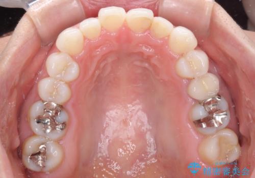 軽度の叢生をインビザライン・ライトで解消の治療前