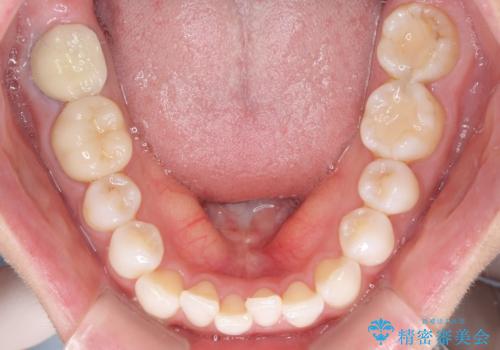 軽度の叢生をインビザライン・ライトで解消の治療前