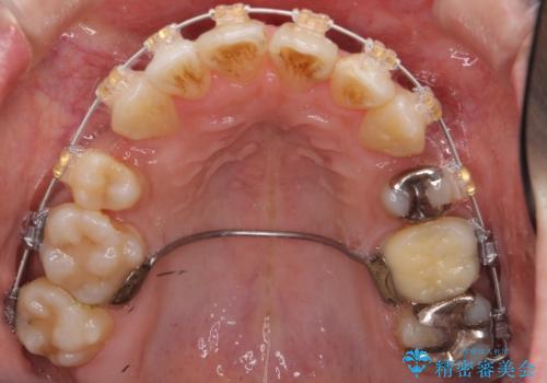 出っ歯 前歯のがたがた 口元を引っ込めたいの治療中