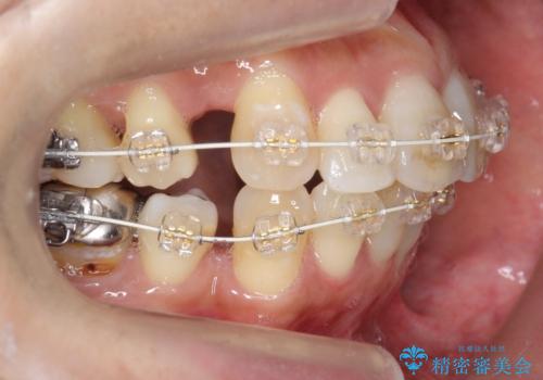 出っ歯 前歯のがたがた 口元を引っ込めたいの治療中