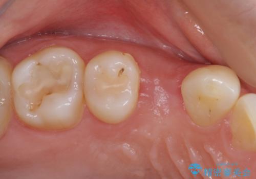 深い虫歯の歯を抜歯 目立つ小臼歯のインプラント治療の治療中