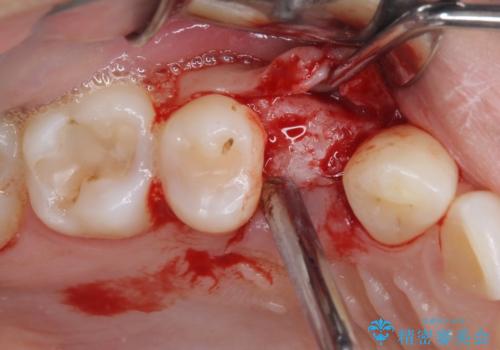 深い虫歯の歯を抜歯 目立つ小臼歯のインプラント治療の治療前