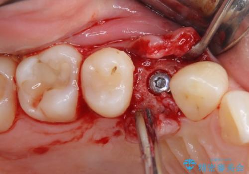 深い虫歯の歯を抜歯　目立つ小臼歯のインプラント治療の治療中