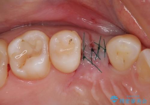 深い虫歯の歯を抜歯　目立つ小臼歯のインプラント治療の治療後
