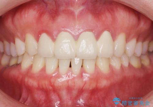 美容外科による不自然なかぶせもので、前歯がコンプレックスに。自然なセラミックにやりかえ 30代女性の治療前