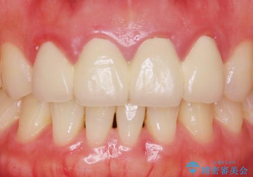 美容外科による不自然なかぶせもので、前歯がコンプレックスに。自然なセラミックにやりかえ 30代女性の治療前