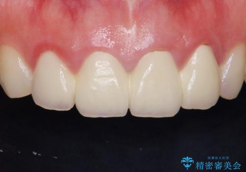 美容外科による不自然なかぶせもので、前歯がコンプレックスに。自然なセラミックにやりかえ 30代女性の症例 治療前