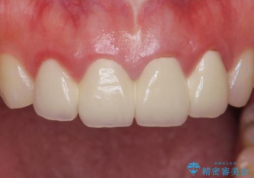 美容外科による不自然なかぶせもので、前歯がコンプレックスに。自然なセラミックにやりかえ 30代女性の治療前